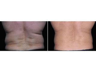 Antes y después Liposucción