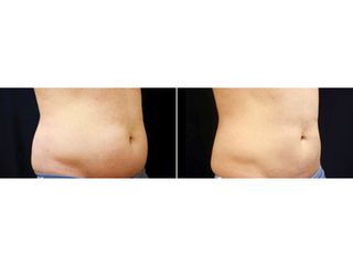 Antes y después Coolsculpting