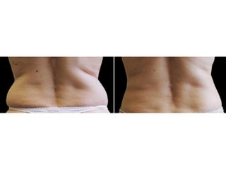 Antes y después Coolsculpting