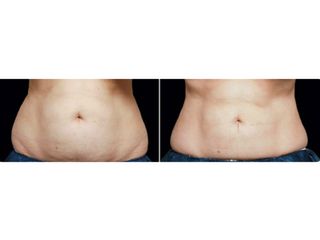 Coolsculpting