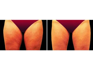 Antes y después Coolsculpting