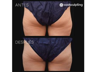 Antes y después Coolsculpting