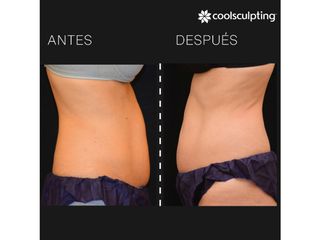 Antes y después Coolsculpting