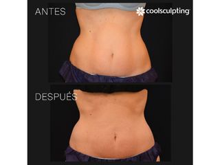 Antes y después Coolsculpting