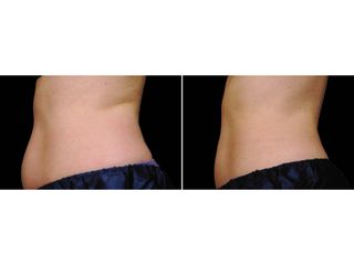 Antes y después Coolsculpting