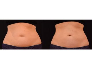 Antes y después Coolsculpting