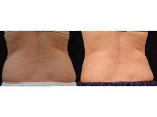 Antes y después Coolsculpting