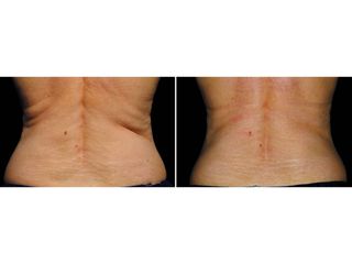 Antes y después Coolsculpting