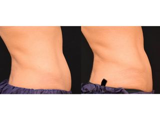 Antes y después Coolsculpting