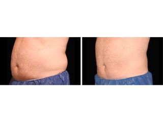 Antes y despues coolsculpting abdomen