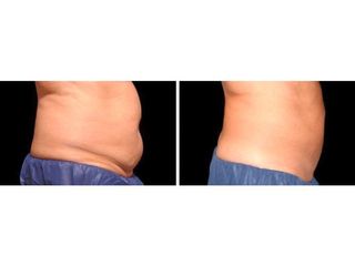Antes y después coolsculpting abdomen