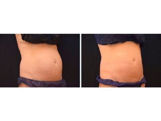 Antes y después coolsculpting abdomen