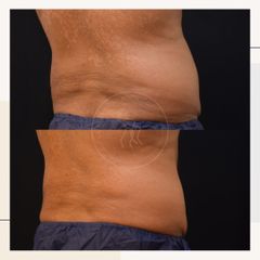 Criolipólisis - Clínica Roso Rodrigues