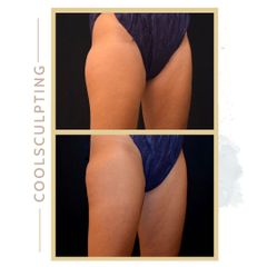 Criolipólisis - Clínica Roso Rodrigues