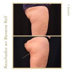 Criolipólisis - Clínica Roso Rodrigues