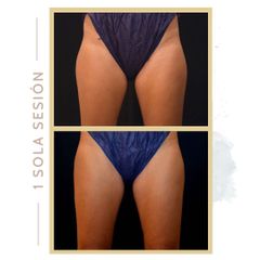 Criolipólisis - Clínica Roso Rodrigues