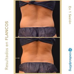 Criolipólisis - Clínica Roso Rodrigues