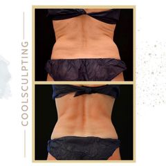 Criolipólisis - Clínica Roso Rodrigues