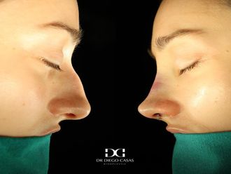 Rinoplastia antes y después - 875730