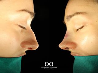 Dr. Diego Casas Sanz - Rinoplastia