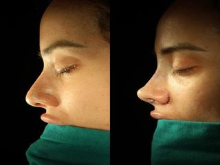 Dr. Diego Casas Sanz - Rinoplastia