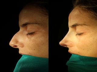 Dr. Diego Casas Sanz - Rinoplastia