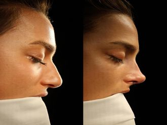 Rinoplastia antes y después - 875739