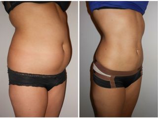 Abdominoplastia
