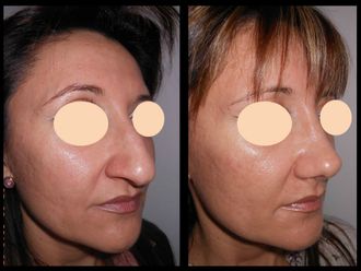 Rinoplastia - 644919