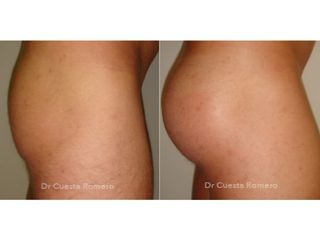 Gluteoplastia