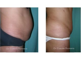 Abdominoplastia - Dr. Carlos Cuesta Romero