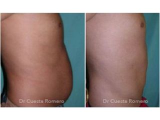 Abdominoplastia - Dr. Carlos Cuesta Romero