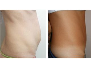 Abdominoplastia