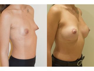 Reconstrucción mamaria