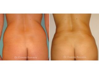 Liposucción - Dr. Carlos Cuesta Romero