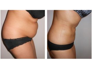 Liposucción - Dr. Carlos Cuesta Romero