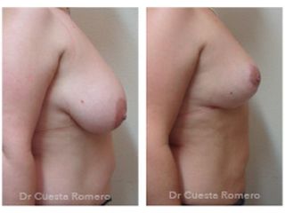 Reducción de senos - Dr. Carlos Cuesta Romero