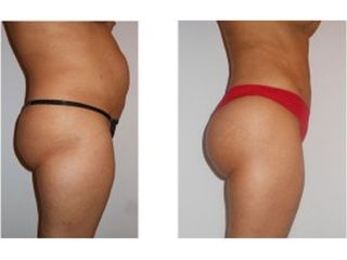 Abdominoplastia - Dr. Carlos Cuesta Romero