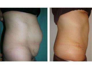 Abdominoplastia - Dr. Carlos Cuesta Romero