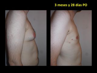Ginecomastia - Dr. Carlos Cuesta Romero