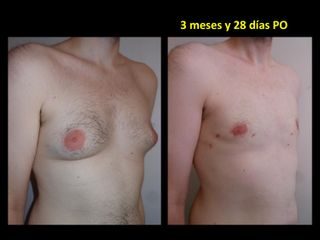 Ginecomastia - Dr. Carlos Cuesta Romero