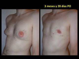 Ginecomastia - Dr. Carlos Cuesta Romero
