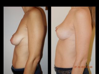 Mastopexia - Dr. Carlos Cuesta Romero