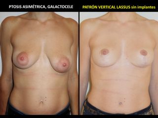 Mastopexia - Dr. Carlos Cuesta Romero