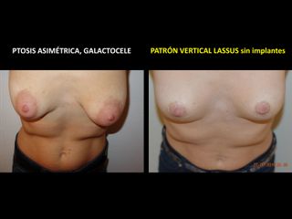 Mastopexia - Dr. Carlos Cuesta Romero