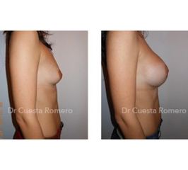 Aumento de pecho - Dr. Carlos Cuesta Romero