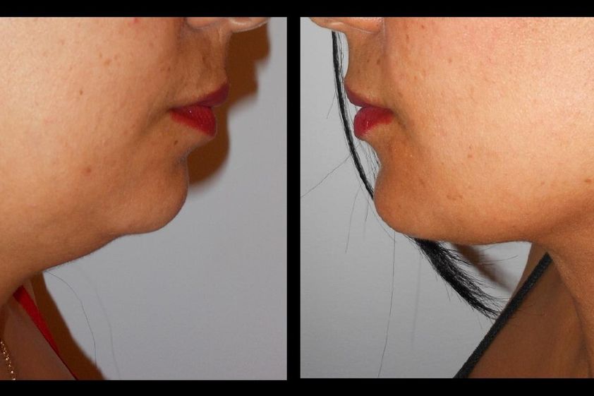 Liposucción de papada antes y después - 864360