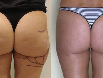 Liposucción antes y después - 869335