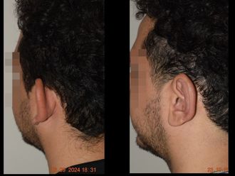 Otoplastia antes y después - 875769