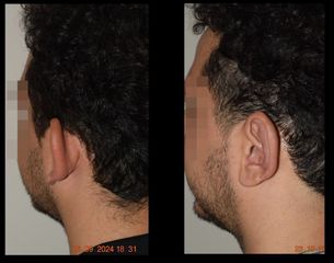Dr. Carlos Cuesta Romero - Otoplastia